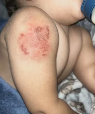 Bebé sufre múltiples mordidas en guardería.